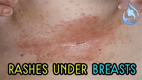 Home Remedies To Treat The Rashes Under The Breasts Youtube