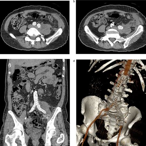 A Post Contrast Ct Abdomen And Pelvis Axial 2 Months After
