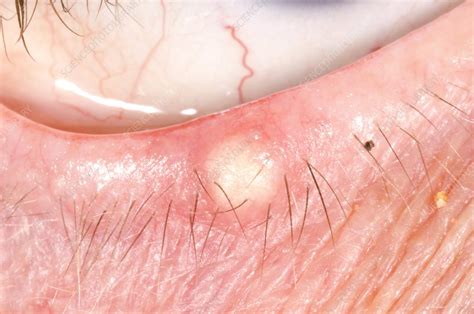 Chalazion In The Lower Eyelid Stock Image C0095252 Science Photo