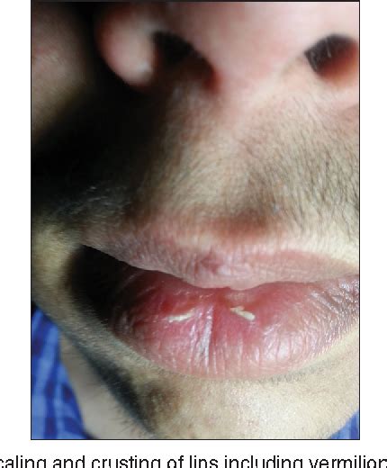 Figure 1 From Exfoliative Cheilitis A Male Patient A Case Report
