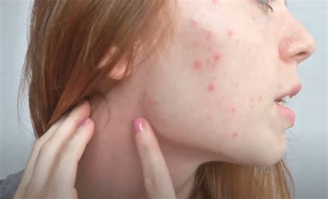 Is Skin Rash An Emerging Symptoms Of Covid 19 Know The