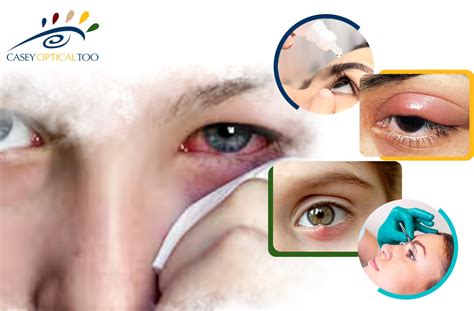 Swollen Eyelids Causes Symptoms And Treatments Casey Optical Too Blog
