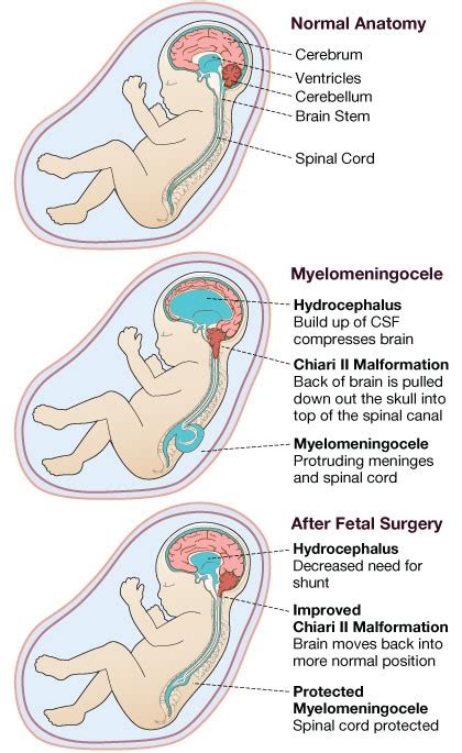 Spina Bifida Types And Treatment Options