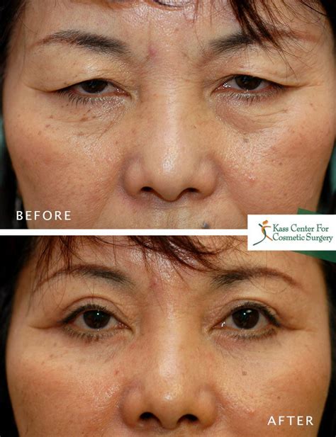 There are also quick in office procedures such as botox. Eyes, Forehead and Festoons | Cosmetic surgery, Surgery ...