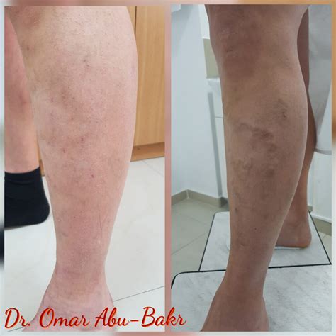 Foam Sclerotherapy Varicose Vein Treatment Varicose Veins Diagnosis