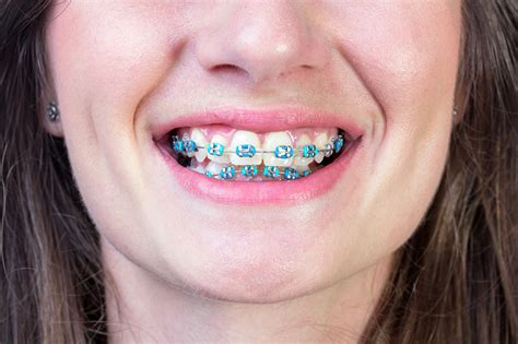 Our featured happy colorful brace'd smile of the week. What Colour Braces Make your Teeth Look Whiter?Evolution ...