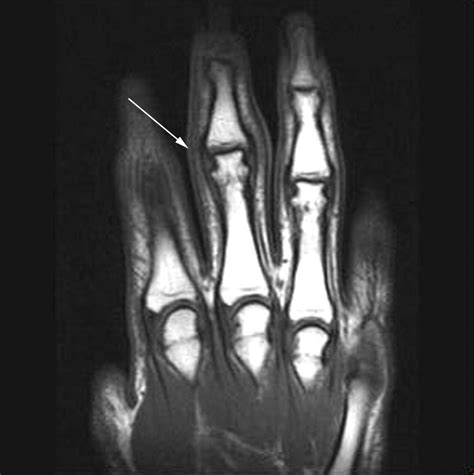 Finger Joint Swellings In A Teenager Juvenile Rheumatoid Arthritis Or