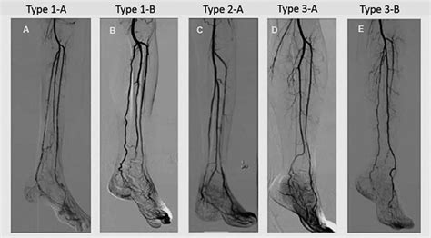 Angiography And Endovascular Therapy For Below The Knee Artery Disease