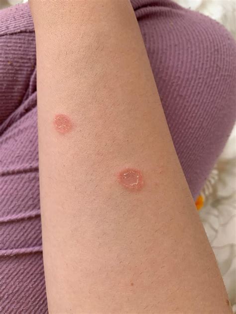 Red Spots On Arms