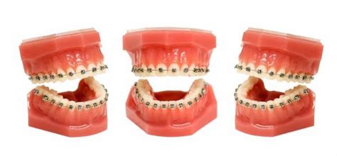 Types Of Dental Braces And Its Benefits Keep Healthy Living