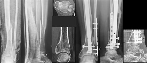 A B Ap And Lateral Radiographs Showing An Aoota 42a1 Fracture In