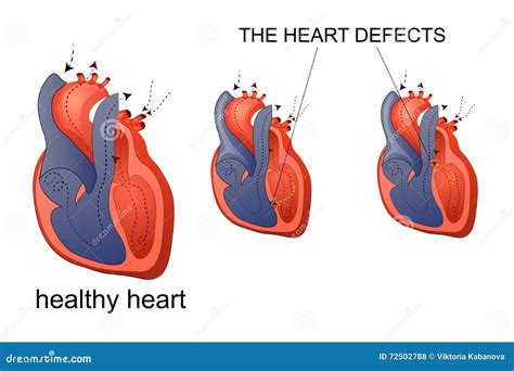 Healthy Aortic Valve Or Aortic Valve Stenosis. Type Of Heart Valve
