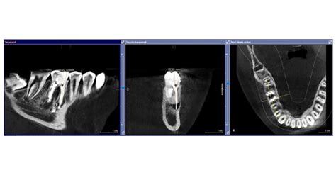 Aplicaciones de la tomografía computarizada en endodoncia Odontologos