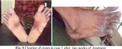 Pdf Crusted Norwegian Scabies Two Case Reports With Hiv Aids