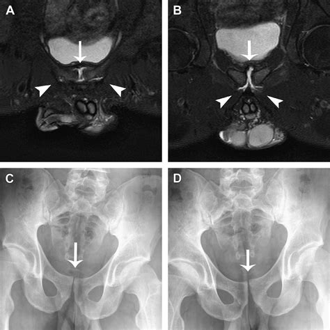 Imaging Of Athletic Pubalgia And Core Muscle Injuries Clinics In