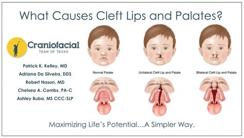 Cleft Lips And Palates Dell Childrens Craniofacial Team Of Texas
