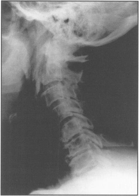 Lateral Cervical Spine Radiograph Demonstrating Gross Surgical