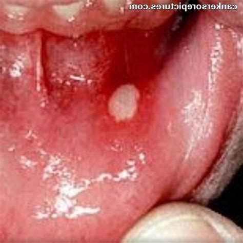 Photos Of Canker Sores On Roof Of Mouth