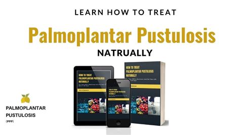 How To Treat Palmoplantar Pustulosis Ppp Naturally Youtube