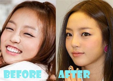Goo Hara Plastic Surgery Before And After Picture Lovely Surgery Celebrity Before And After