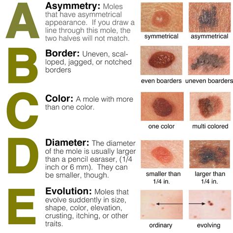 May Is Skin Cancer Awareness Month Skin Cancer Is An Equal Opportunity Disease Dermatology