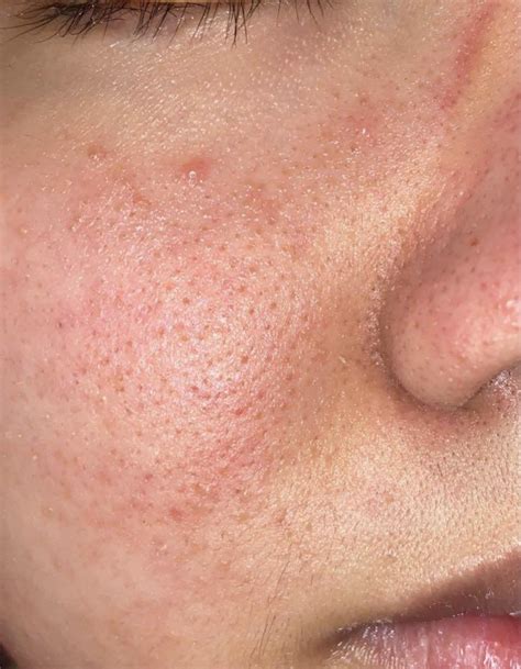 Skin Concerns Bumpy Texture And Enlarged Pores Redness Near Cheek