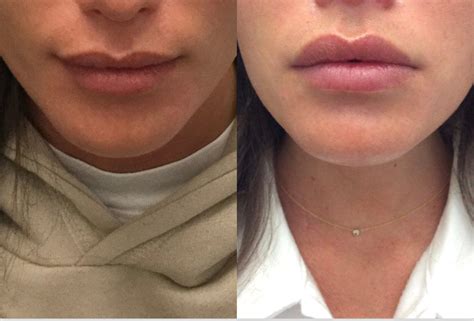 a lip flip can give you fuller poutier lips in 20 minutes here s how the botox procedure works