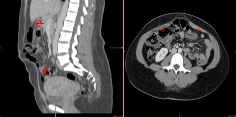 Ct Scan Abdomen Showing Hernia With Divarication Arrows