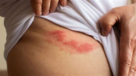 shingles signs symptoms and treatment chittenango news