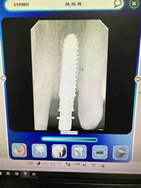 Implant Dentist In Glenn Heights Tx Implant Dentist Implant