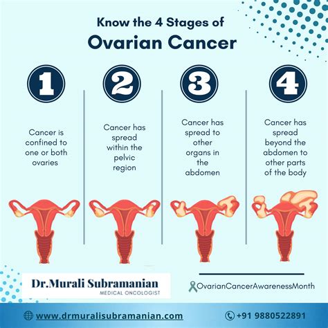 4 Stages Of Ovarian Cancer Best Medical Oncologist In Kalyan Nagar By