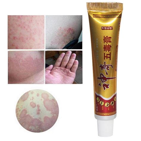 Chinese Herbal Psoriasis Relief Cream Casta Trends Shop