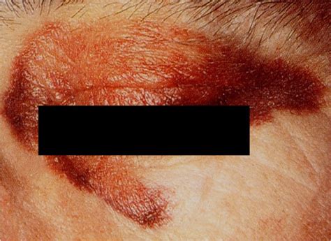 Periorbital Ecchymoses In A Patient With Cutaneous Amyloidosis