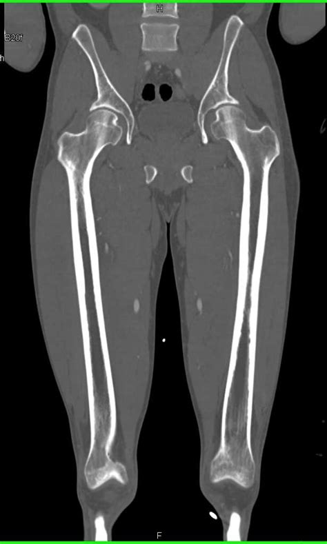 Fracture Distal Right Tibia And Fibula With Vascular Spasm