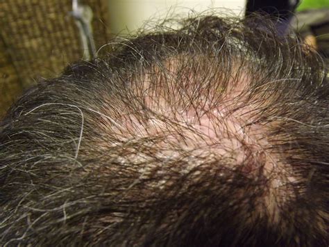 But in this case, follicles are also swollen (just like in folliculitis). 301 Moved Permanently