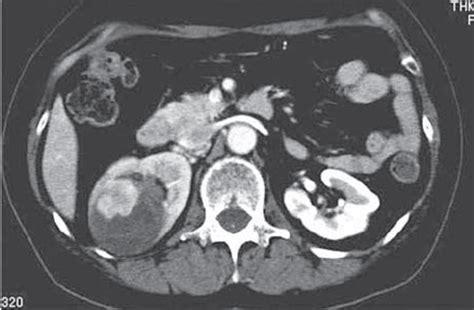 Computed Tomography Scan Showing A Right Renal Tumor 25 × 15 Cm