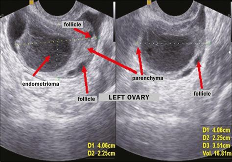 Endometriosis Transvaginal Ultrasound