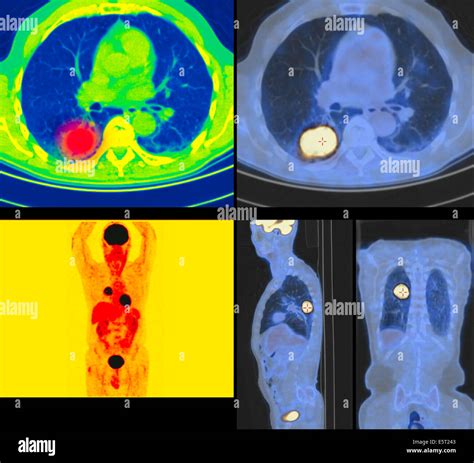 Positron Emission Tomography Pet Scans Of A Patient With A Tumour