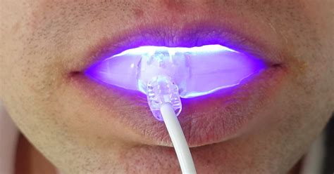 Is There A Link Between Uv Light Teeth Whitening And Cancer Dental Health Society