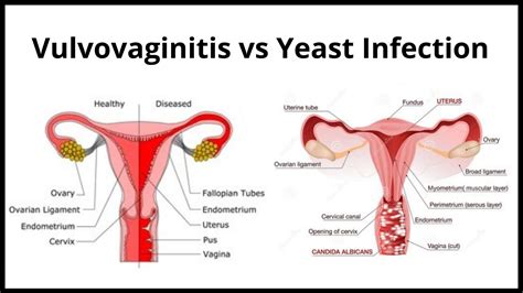 Vulvovaginitis Vs Yeast Infection Symptoms And Treatment Needed