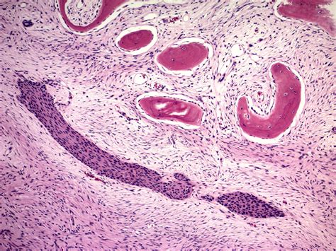 Pathology Outlines Adamantinoma