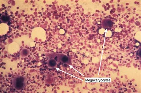 Immune Thrombocytopenic Purpura Itp Stepwards