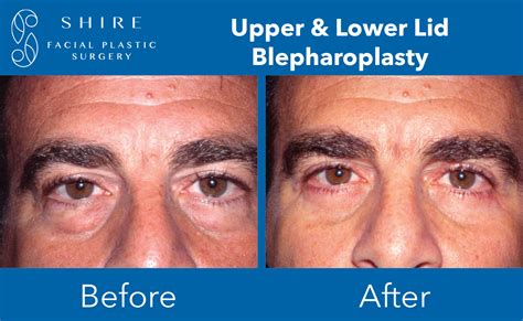 Blepharoplasty Before After Group 15 1 Shire Facial Plastic Surgery