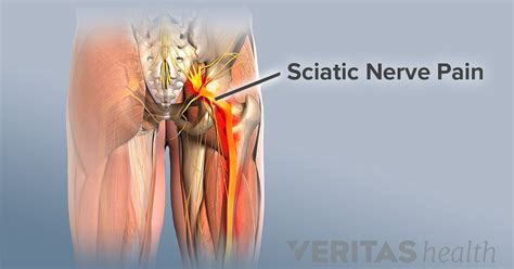 Sciatica is leg pain caused by a pinched nerve. 5 Tips to Relieve Sciatica Pain