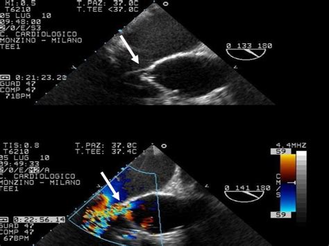 Non Infective Severe Aortic Paravalvular Leakage 7 Years After Surgery