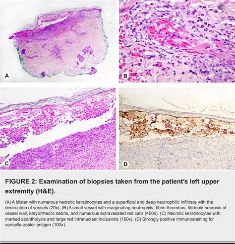 Figure 2 From Herpes Zoster Presenting As Cutaneous Vasculitis In The