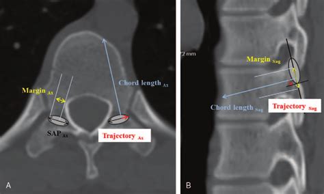 The Axial A And Sagittal B Ct Image Showing The Radiological