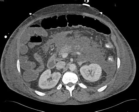 Acute Pancreatitis Pancreas Case Studies Ctisus Ct Scanning