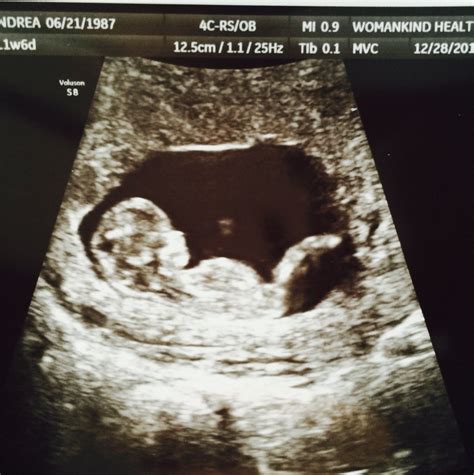 Ultrasound At Weeks Pregnant Images And Photos Finder