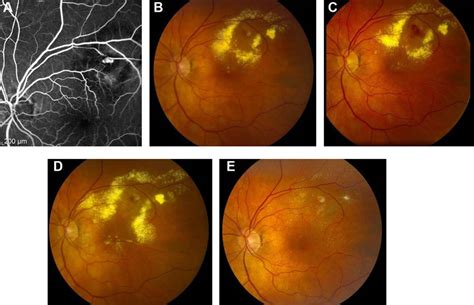 Fluorescein Angiography And Fundus Photographs Notes A Fluorescein